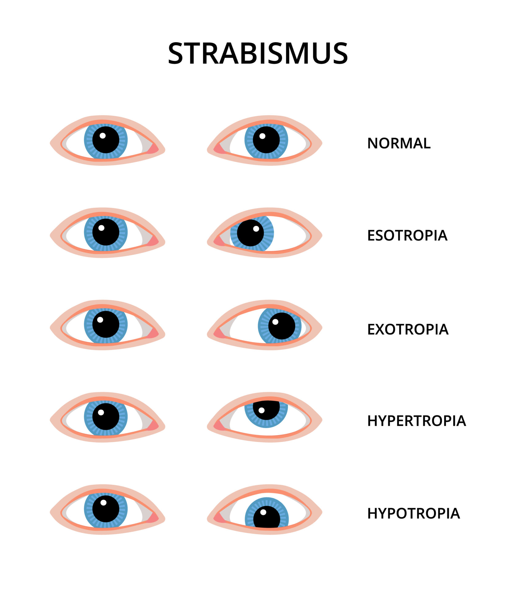 Going Cross-Eyed? Discover the Facts About Adult Strabismus